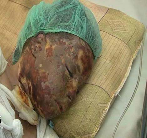 صور تحكي إبادة آل سعود لليمنيين: ضحايا أحرقت أجسادهم صواريخ محرّمة دولياً