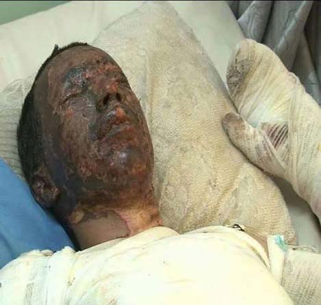 صور تحكي إبادة آل سعود لليمنيين: ضحايا أحرقت أجسادهم صواريخ محرّمة دولياً