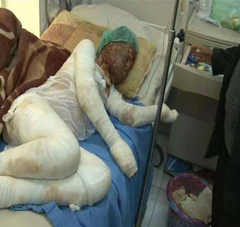 صور تحكي إبادة آل سعود لليمنيين: ضحايا أحرقت أجسادهم صواريخ محرّمة دولياً