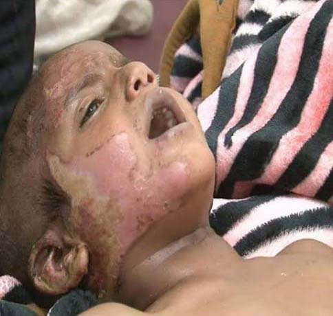 صور تحكي إبادة آل سعود لليمنيين: ضحايا أحرقت أجسادهم صواريخ محرّمة دولياً