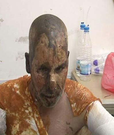 صور تحكي إبادة آل سعود لليمنيين: ضحايا أحرقت أجسادهم صواريخ محرّمة دولياً