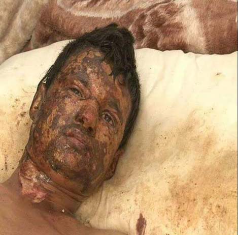 صور تحكي إبادة آل سعود لليمنيين: ضحايا أحرقت أجسادهم صواريخ محرّمة دولياً