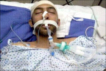 علي الموالي في غيبوبة تحت التخدير منذ أكثر من أسبوع نتيجة للإصابة الغادرة من قبل النظام البحريني

