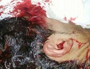 إصابة خطرة في رأس شاب من &rsquo;كرزكان&rsquo; بالبحرين جراء القمع