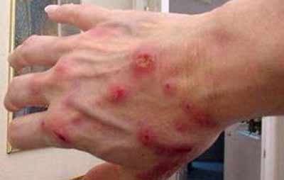 مرض وبائي يصيب معتقلي سجن جو البحريني. والأسباب؟
