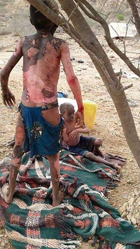 السعودية ترتكب مجزرة مروّعة: أُسرة يمنية تُحرق بصواريخ مملكة القهر!