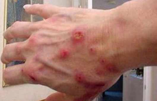 مرض وبائي يصيب معتقلي سجن جو البحريني. والأسباب؟
