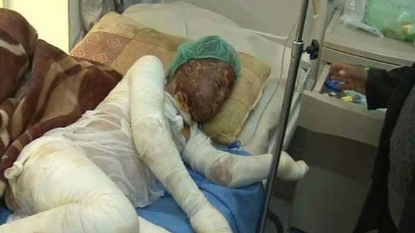 صور تحكي إبادة آل سعود لليمنيين: ضحايا أحرقت أجسادهم صواريخ محرّمة دولياً