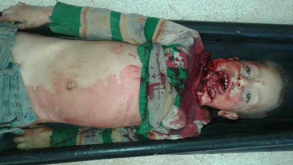 بالصور.. أطفالٌ شهداء في كفريا والفوعة أمام مرأى الأمم المتحدة