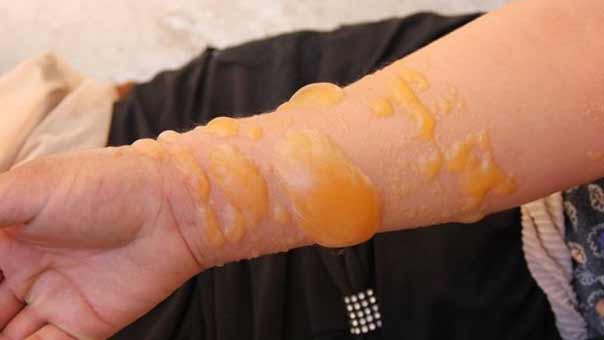 8 اصابات بقذائف سامة قصف بها داعش بلدتين في ريف حلب