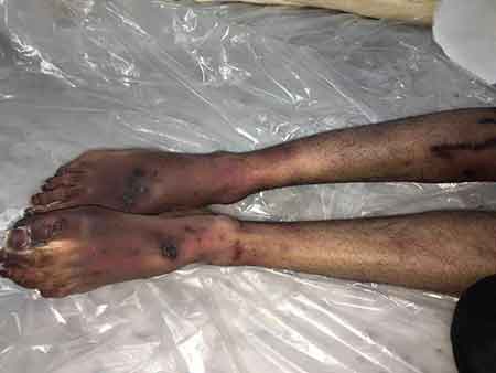 جثمان مكي علي العريض يكشف زيف ادّعاءات آل سعود: التعذيب سبب شهادته وليس خوفه من التحقيق!