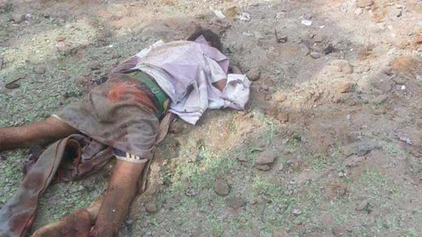 همجية ال سعود تطال المستشفيات وتقتل الاطفال في اليمن