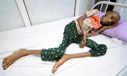 اليمن في رأس قائمة الدول العربية الأكثر مجاعة.. ما يزيد عن 1.5 مليون طفل يعانون الجوع