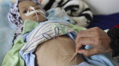 اليمن في رأس قائمة الدول العربية الأكثر مجاعة.. ما يزيد عن 1.5 مليون طفل يعانون الجوع