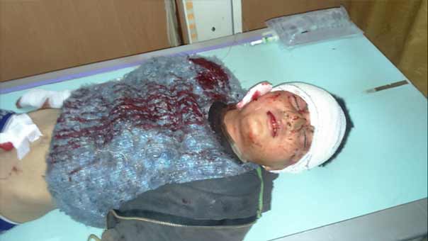 بالصور: 10 إصابات في مدينتي نبّل والزهراء شمال حلب بقذائف صاروخية مصدرها المجموعات المسلحة 