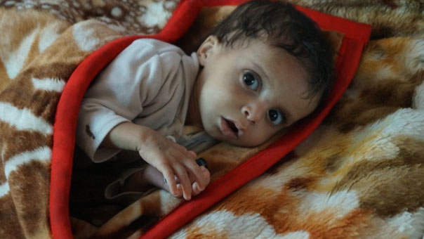 الحرب والحصار يتسببان في موت طفل يمني دون الـ5 كل 10 دقائق