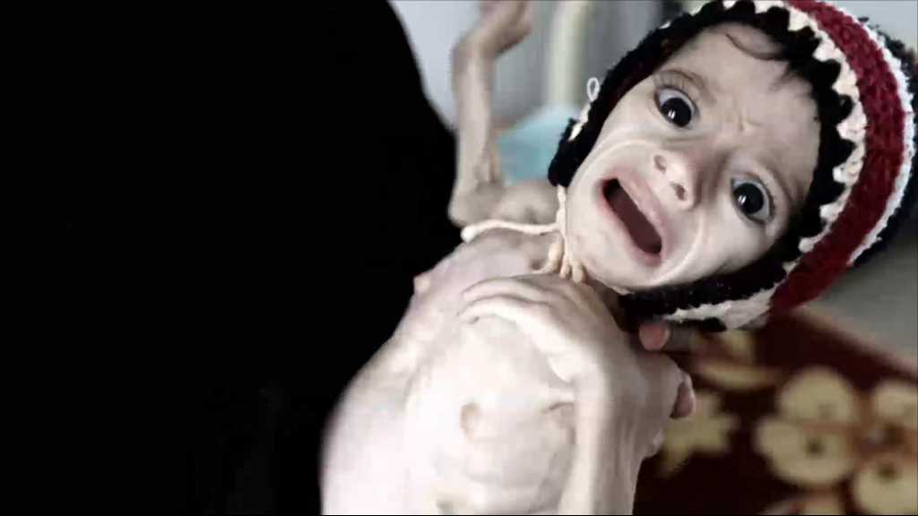 اليونيسف: 11 مليون طفل يمني بحاجة لمساعدات إنسانية..