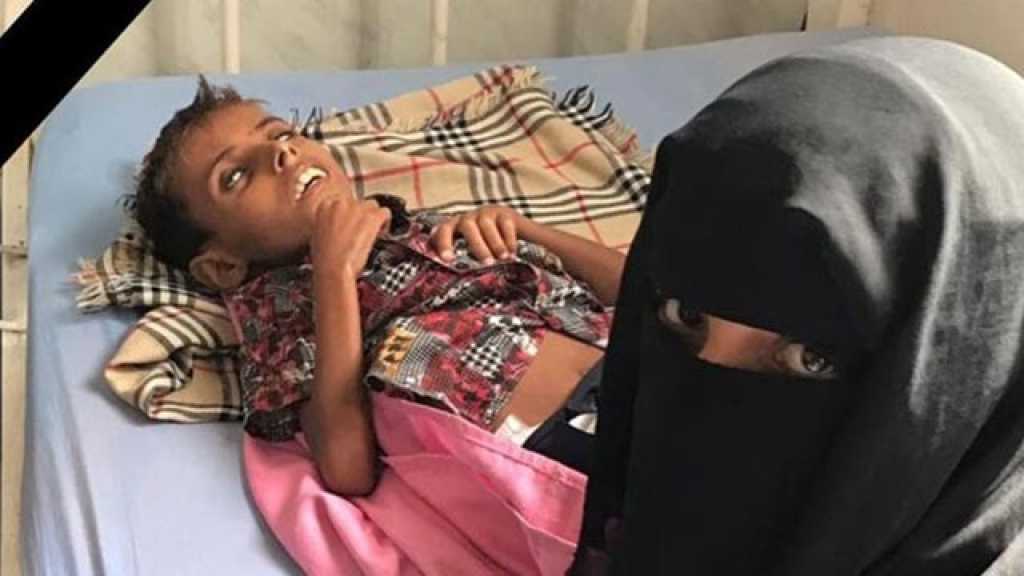 اليونيسف: وفاة طفل يمني نتيجة نقص التغذية الحاد في الحديدة