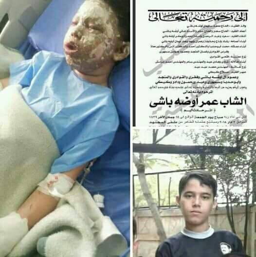 ماذا قال طفل حي ركن الدين الدمشقي لـ’العهد’؟.. عمر يستعيد وجهه الملائكي الذي أحرقه الإرهابيون